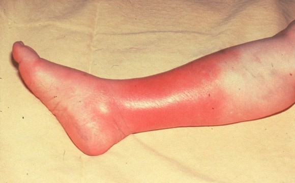 Inflammed leg